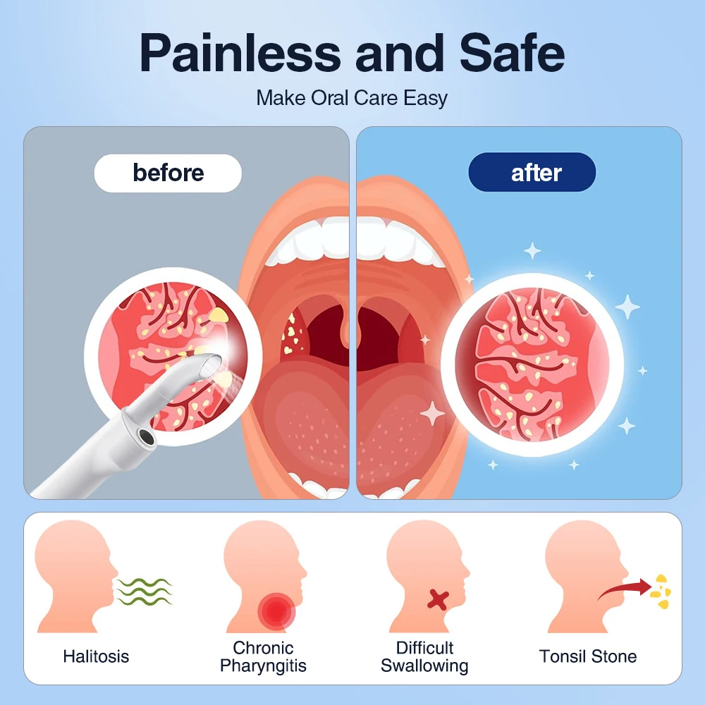 Electric Visible Vacuum Tonsil Stone Remover Kit with 3 Suction Modes Oral Care Tool for Tonsil Stones Removal Oral Fresh Care - Image 5